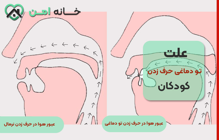 تشخیص علت تو دماغی حرف زدن کودکان